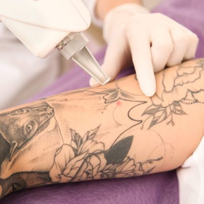 LASER-TATTOO-REMOVAL.jpg
